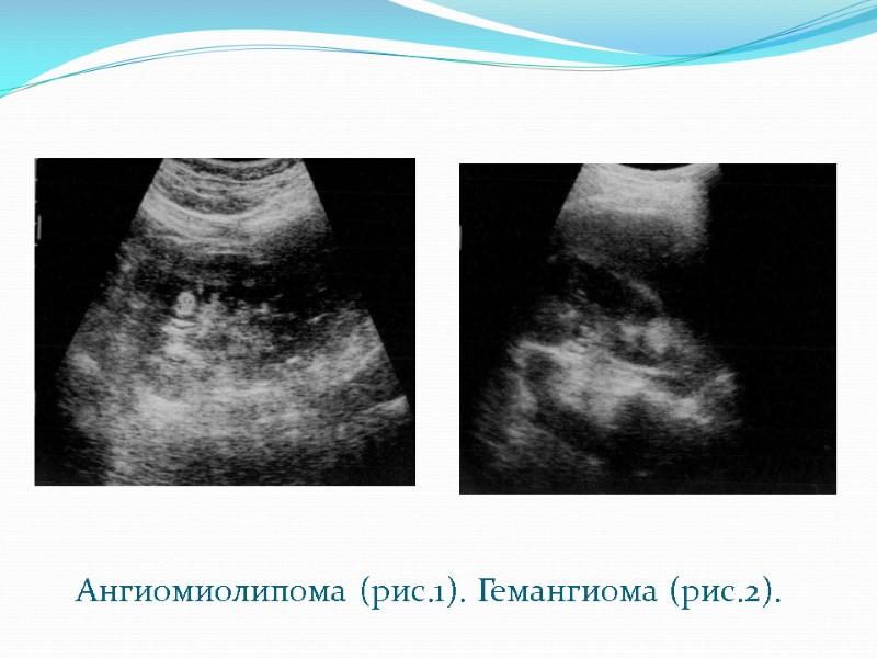 Ангиомиолипома (рис.1). Гемангиома (рис.2).